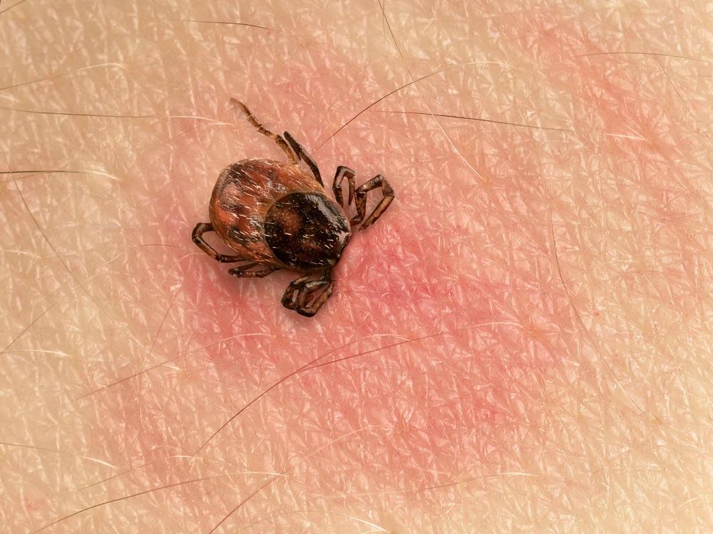 Tick Safety -Tick Removal Kit for Your First-aid kit, Car/RV/Home/Work - SERVOXY INC